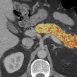 AI finds signs of pancreatic cancer before tumors develop