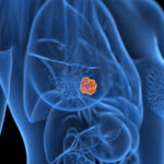 FDA Panel Gives Thumbs Down to Novel Strategy for Switching Breast Cancer Therapy